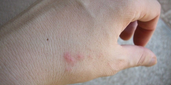 swelling on hand