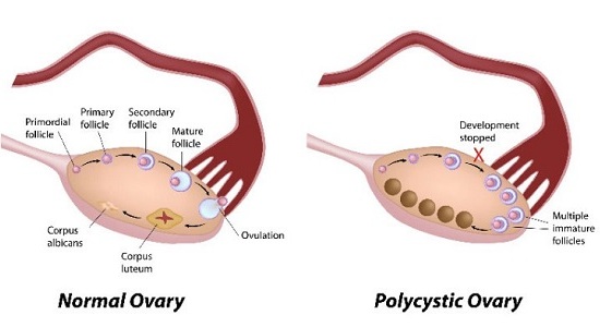 PCOS in women health problems