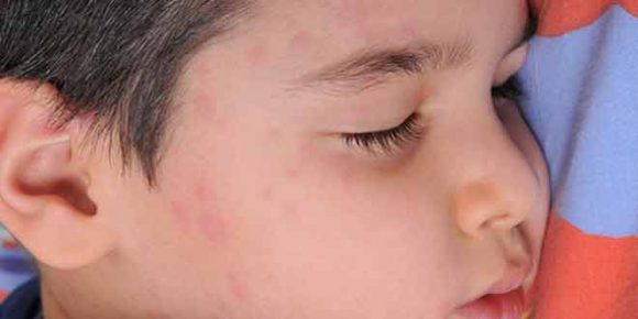 symptoms of measles and home remedies