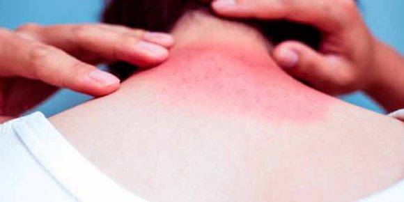 tips to avoid sunburn and two tone skin