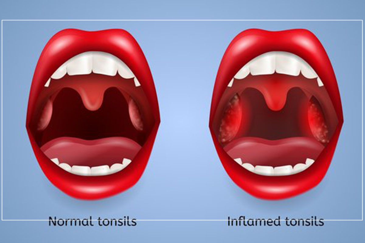 4-foods-to-cure-tonsillitis