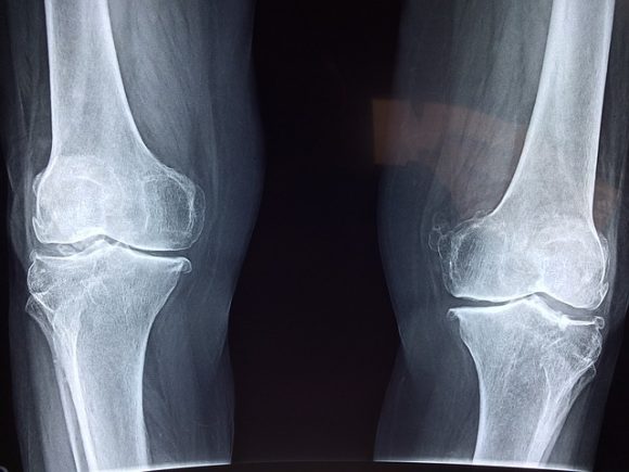Damage to Joints and Bones