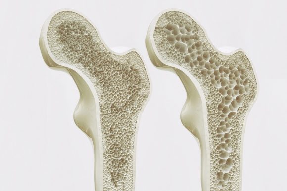 osteoporosis subhead