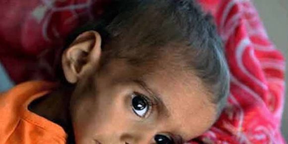 Tharparker: Food Shortage Kills Two More Child – 56 children Dead in 22 Days