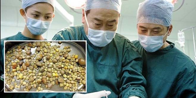 doctors-in-china-remove-420-kidney-stones-from-patient-htv