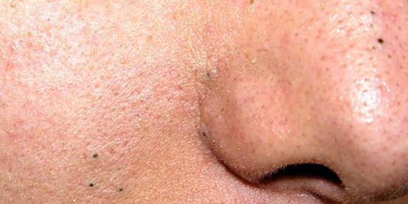 8 causes of blackheads you need to know about - HTV