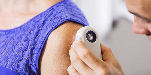 Online Test Evaluates Skin Cancer