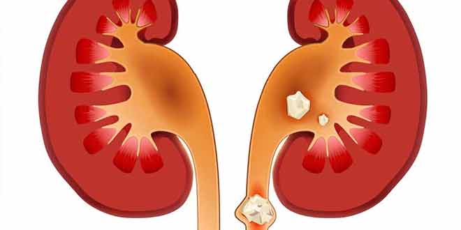 Kidney Stones and Diet - HTV