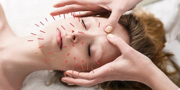 History Of Acupuncture