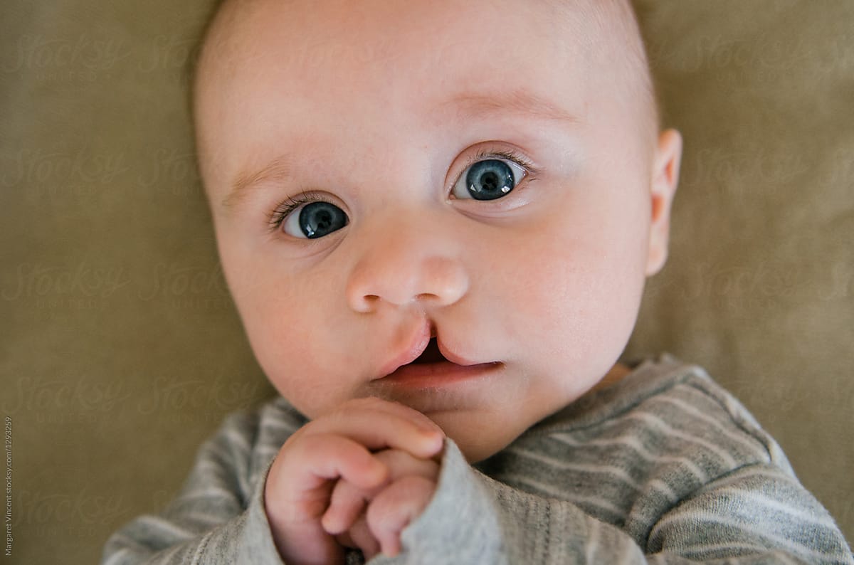 All About Cleft Lip And Palate What You Should Expect And Know
