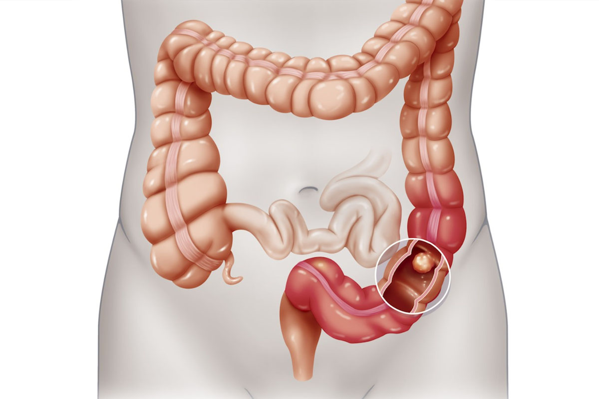 Intestinal Obstruction: Overview, Symptoms, Diagnosis, and ...