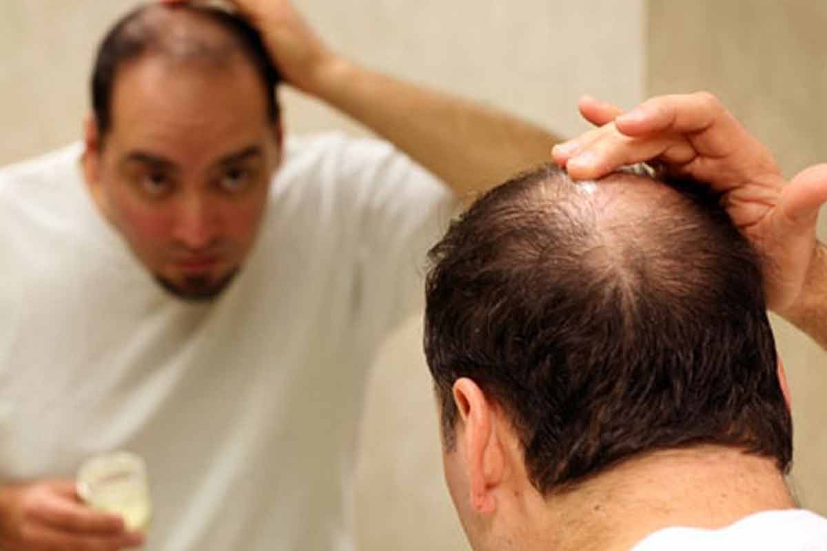 Natural Treatment for Male Pattern Baldness  HTV