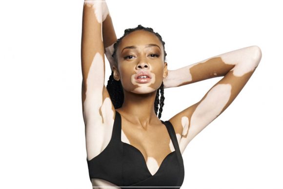 These Women Are Rocking Vitiligo And So Should You