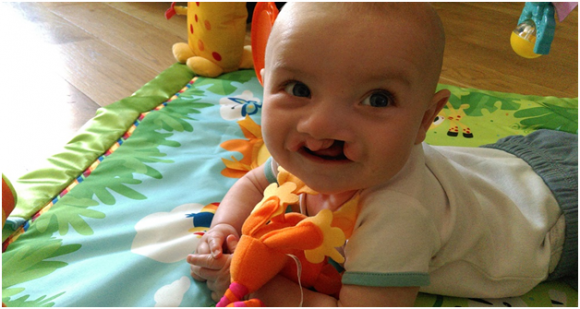 All about Cleft Lip and Palate: What You Should Expect and Know