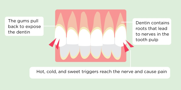 Sensitive Teeth - Symptoms and Precautions1